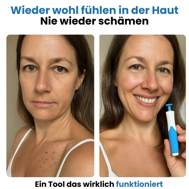 Auto Skin Tag Remover Kit