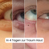 Auto Skin Tag Remover Kit